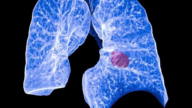 肺癌筛查